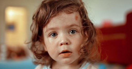 young girl has a red mark on her forehead KHM Attorneys at Law Colorado Springs, Castle Rock